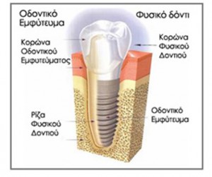 Προσθετική επι Εμφυτευμάτων - Λαμπροπούλου Οδοντίατρος Πατρα